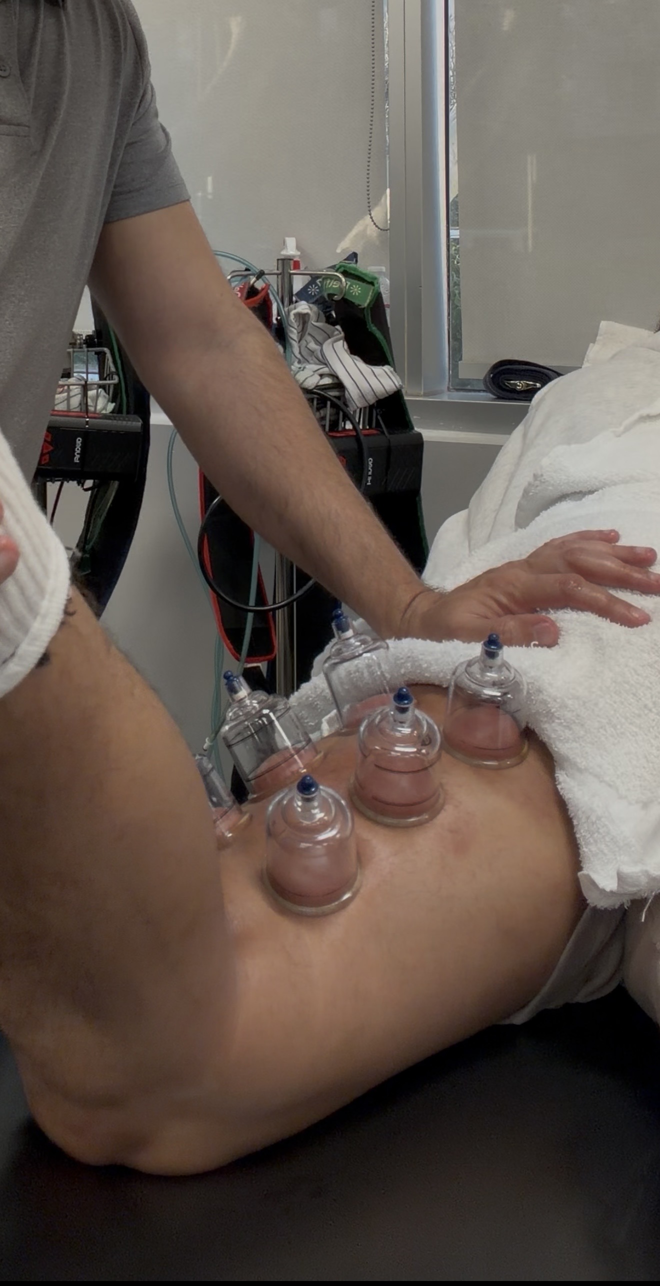 Person receiving cupping therapy on their thigh in a clinical setting, with medical equipment nearby.