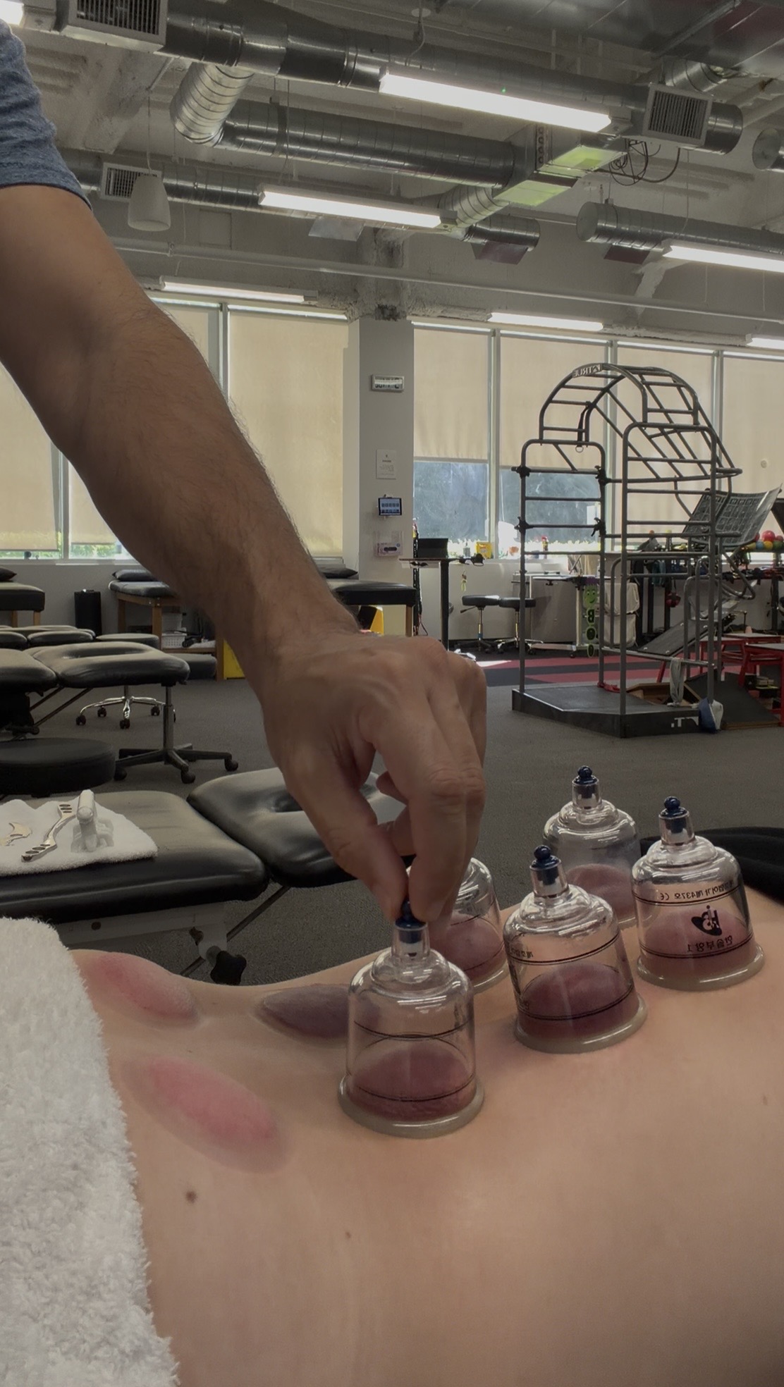 Person's hand placing small glass jars on a person's back in a clinical setting.